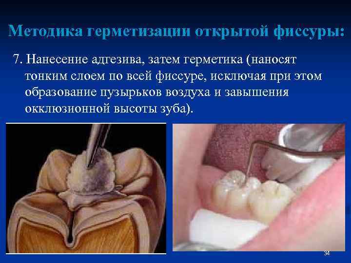 Методика герметизации открытой фиссуры: 7. Нанесение адгезива, затем герметика (наносят тонким слоем по всей