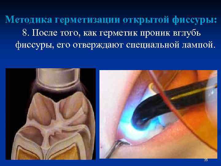 Методы герметизации фиссур