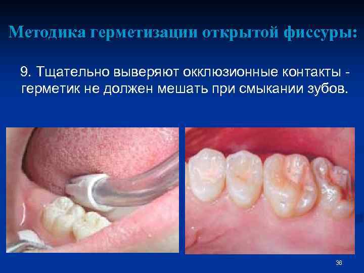 Методика герметизации открытой фиссуры: 9. Тщательно выверяют окклюзионные контакты герметик не должен мешать при