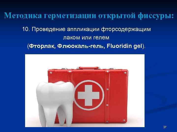 Методика герметизации открытой фиссуры: 10. Проведение аппликации фторсодержащим лаком или гелем (Фторлак, Флюокаль-гель, Fluoridin