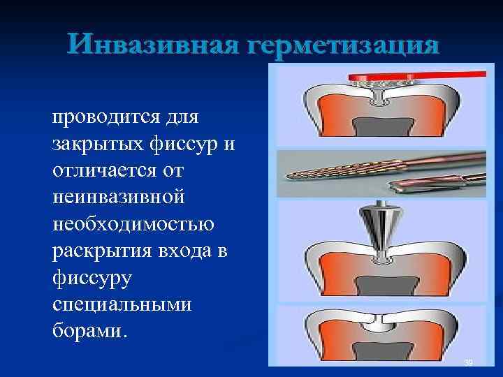 Герметизация фиссур презентация