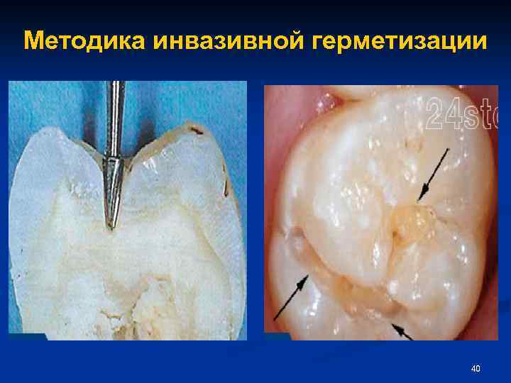 Методика инвазивной герметизации 40 