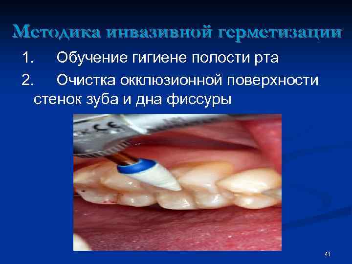 Методика инвазивной герметизации 1. Обучение гигиене полости рта 2. Очистка окклюзионной поверхности стенок зуба