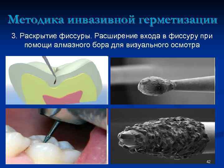 Методы герметизации фиссур