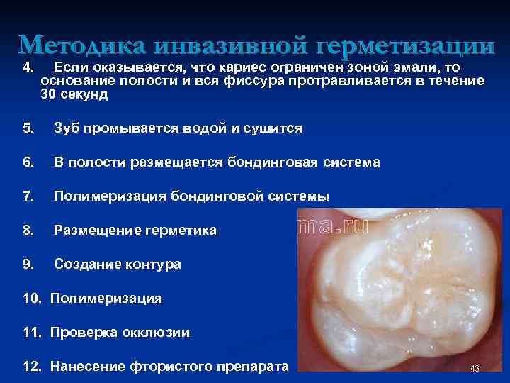 Методика инвазивной герметизации 4. Если оказывается, что кариес ограничен зоной эмали, то основание полости