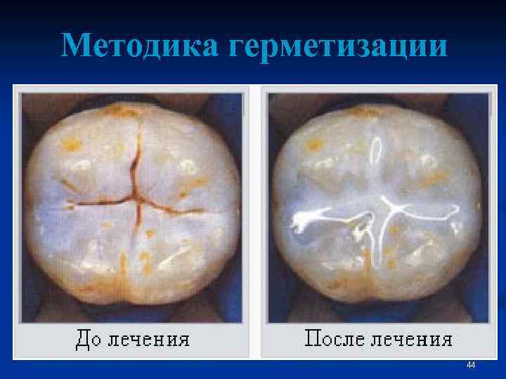 Методика герметизации 44 