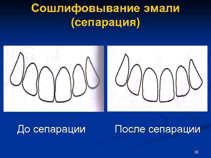 Сошлифовывание эмали (сепарация) До сепарации После сепарации 60 