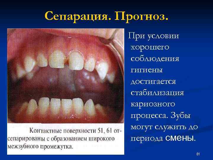 Сепарация. Прогноз. При условии хорошего соблюдения гигиены достигается стабилизация кариозного процесса. Зубы могут служить