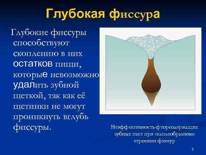 Глубокая фиссура Глубокие фиссуры способствуют скоплению в них остатков пищи, которые невозможно удалить зубной