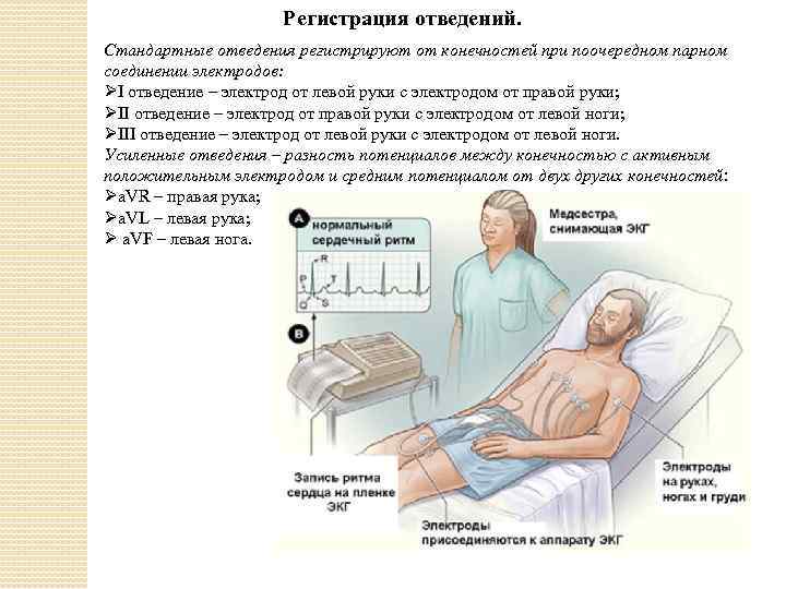 Снять экг наложение электродов фото как правильно