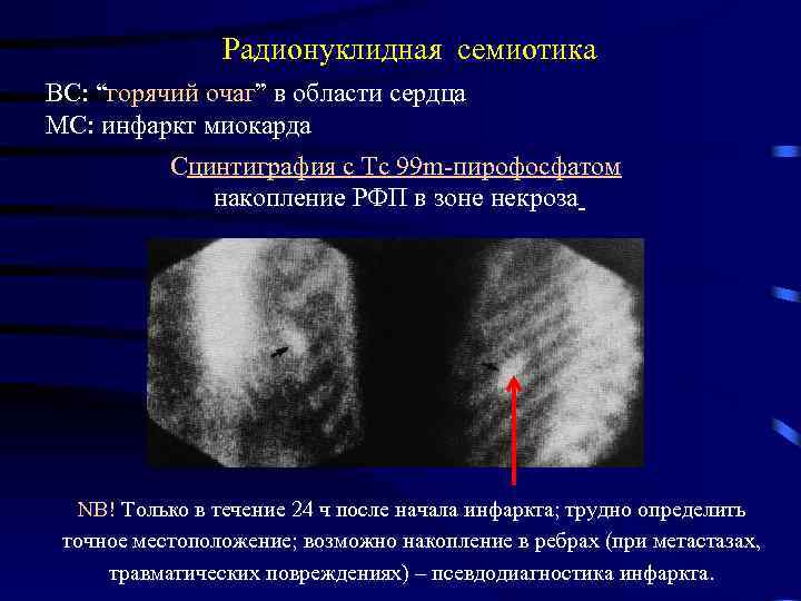 Радионуклидная семиотика ВС: “горячий очаг” в области сердца МС: инфаркт миокарда Сцинтиграфия с Tc