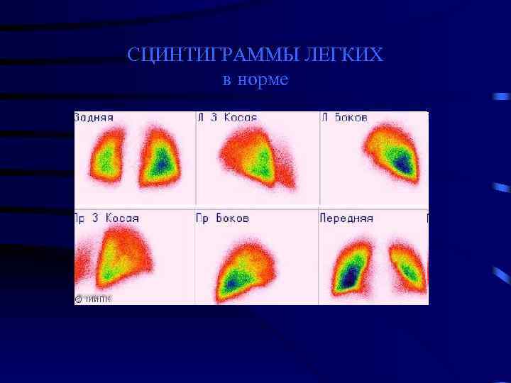 СЦИНТИГРАММЫ ЛЕГКИХ в норме 