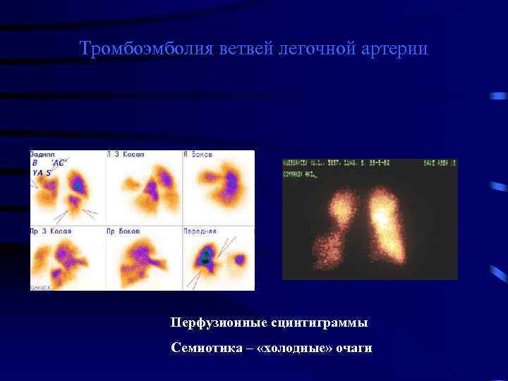Тромбоэмболия ветвей легочной артерии Перфузионные сцинтиграммы Семиотика – «холодные» очаги 