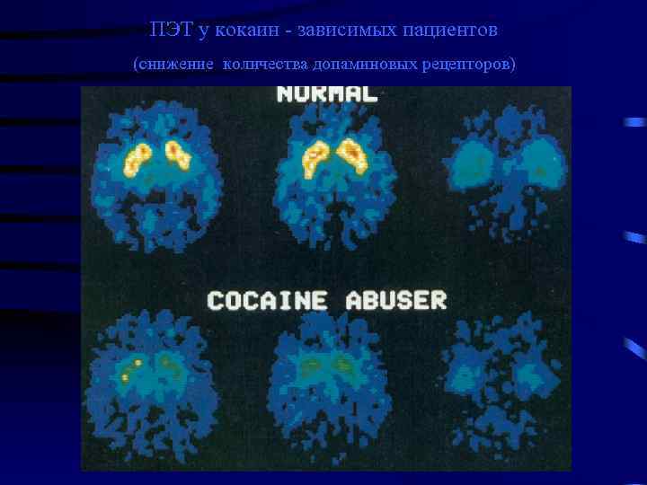 ПЭТ у кокаин - зависимых пациентов (снижение количества допаминовых рецепторов) 