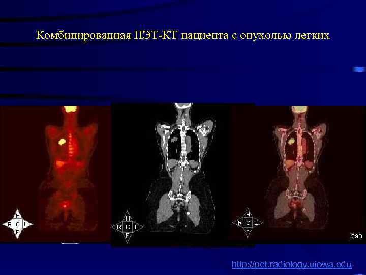 Комбинированная ПЭТ-КТ пациента с опухолью легких http: //pet. radiology. uiowa. edu 