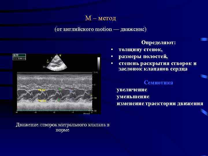 М метод. Конкордантное движение створок митрального клапана. Переднесистолическое движение створок митрального клапана. Разнонаправленное движение створок митрального клапана. Эхокардиография митральный клапан движение створок.