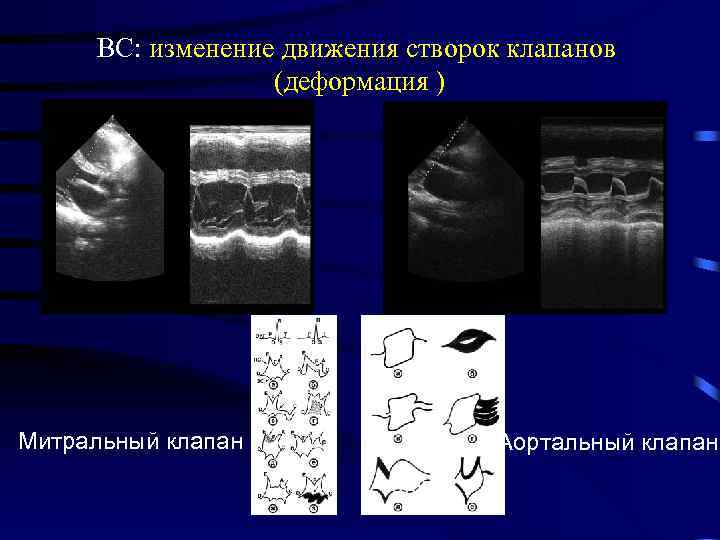 Митральный клапан сколько створок