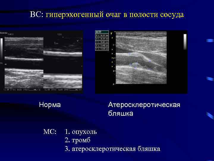 ВС: гиперэхогенный очаг в полости сосуда Норма МС: Атеросклеротическая бляшка 1. опухоль 2. тромб
