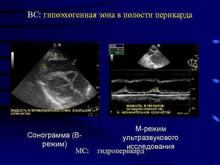 ВС: гипоэхогенная зона в полости перикарда Сонограмма (Врежим) МС: М-режим ультразвукового исследования гидроперикард 