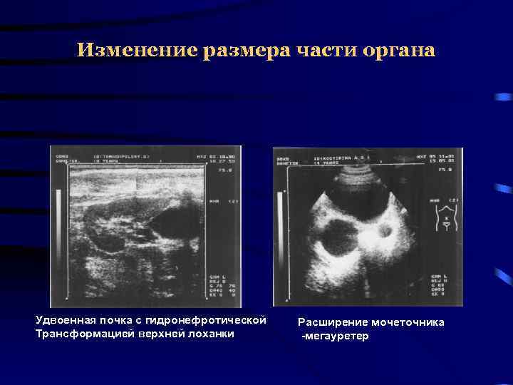 Мегауретер у детей презентация