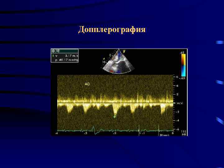 Допплерография 