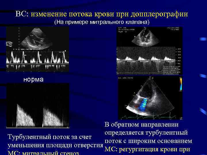ВС: изменение потока крови при допплерографии (На примере митрального клапана) норма В обратном направлении