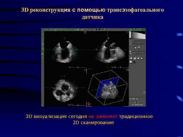 3 D реконструкция с помощью трансэзофагеального датчика 3 D визуализация сегодня не заменяет традиционное