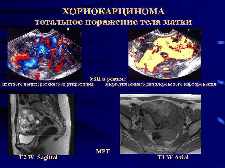 ХОРИОКАРЦИНОМА тотальное поражение тела матки УЗИ в режиме цветного допплеровского картирования T 2 W
