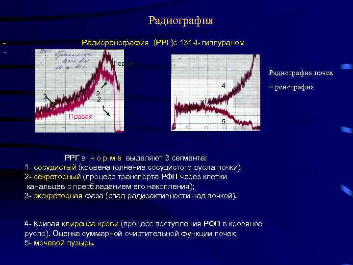 Радиография Радиоренография (РРГ)с 131 -I- гиппураном - Левая Радиография почек 4 2 2 3