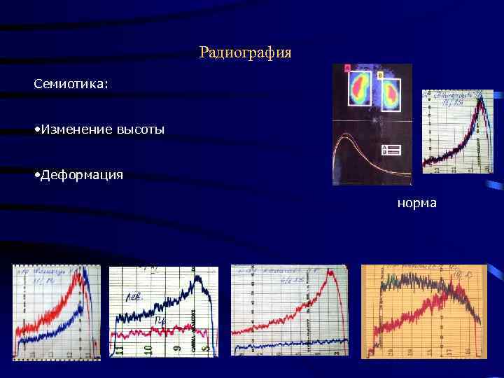 Радиография Семиотика: • Изменение высоты • Деформация норма 