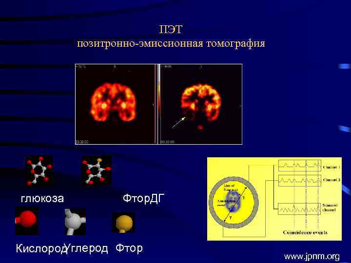 ПЭТ позитронно-эмиссионная томография глюкоза Фтор. ДГ Углерод Фтор Кислород www. jpnm. org 