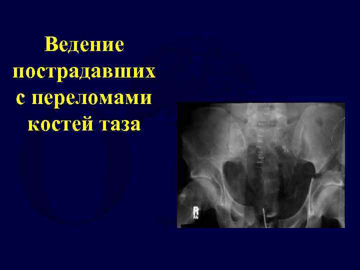 Множественный перелом костей таза. Набор инструментов при переломах костей таза. Забор км из тазовой кости фото.