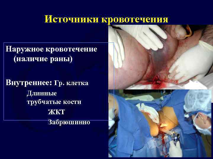Источники кровотечения Наружное кровотечение (наличие раны) Внутреннее: Гр. клетка Длинные трубчатые кости ЖКТ Забрюшинно