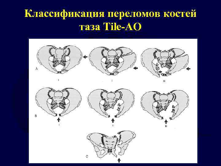 Перелом таза положение лягушки