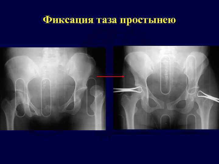 Фиксация таза простынею 