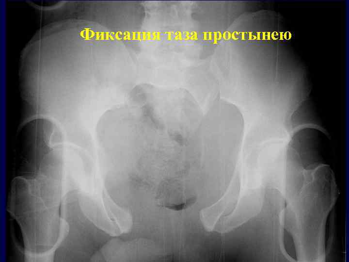 Фиксация таза простынею 