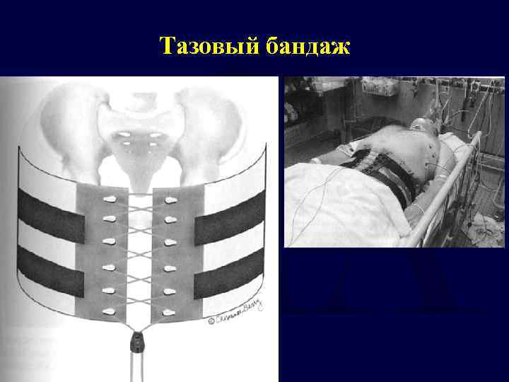 Тазовый бандаж 