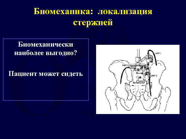 Биомеханика: локализация стержней Биомеханически наиболее выгодно? Пациент может сидеть 