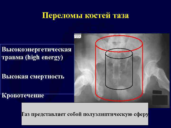 Переломы таза травматология презентация