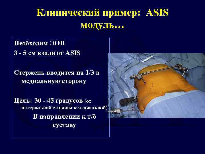 Клинический пример: ASIS модуль… Необходим ЭОП 3 - 5 cм кзади от ASIS Стержень