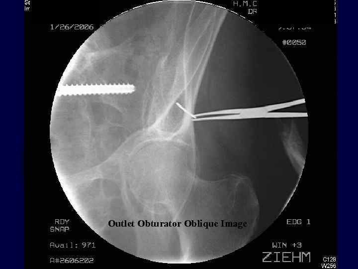 Outlet Obturator Oblique Image 