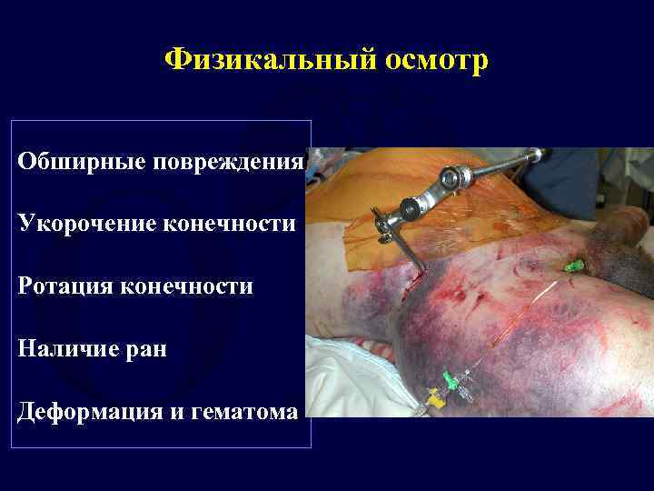 Физикальный осмотр Обширные повреждения Укорочение конечности Ротация конечности Наличие ран Деформация и гематома 