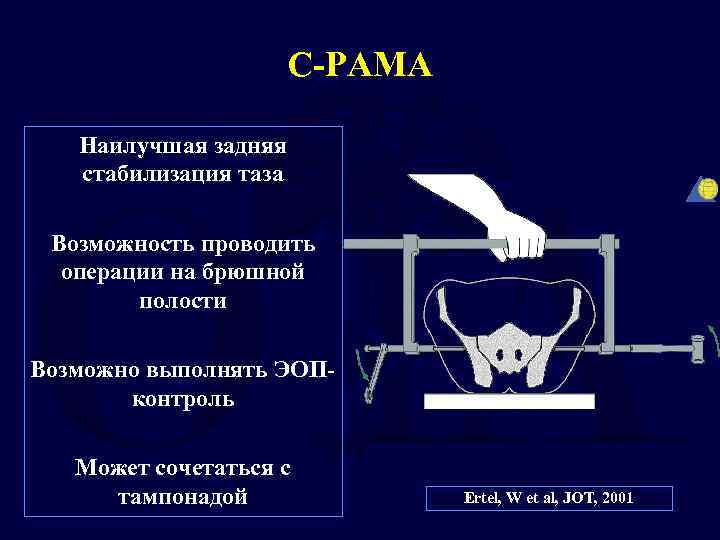 С-РАМА Наилучшая задняя стабилизация таза Возможность проводить операции на брюшной полости Возможно выполнять ЭОПконтроль