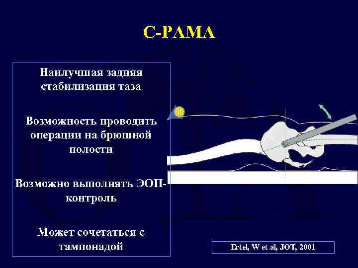 С-РАМА Наилучшая задняя стабилизация таза Возможность проводить операции на брюшной полости Возможно выполнять ЭОПконтроль
