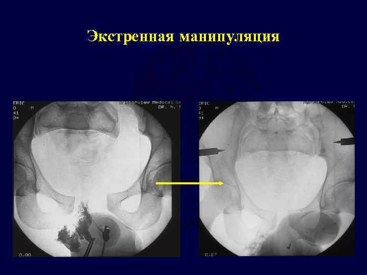 Экстренная манипуляция 