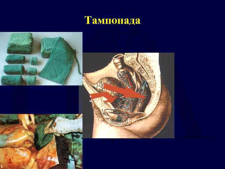 Тампонада 