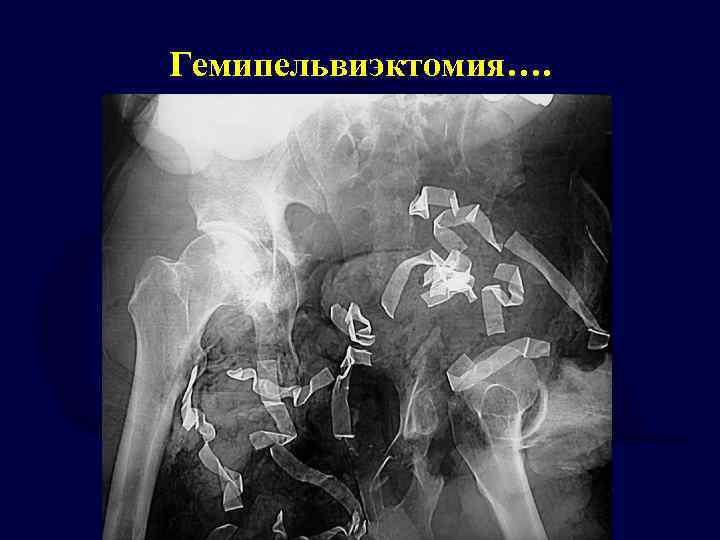 Гемипельвиэктомия…. 