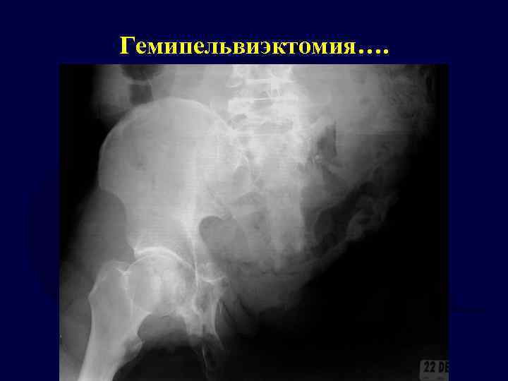 Гемипельвиэктомия…. 