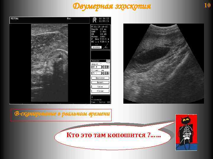 Двумерная эхоскопия В-сканирование в реальном времени Кто это там копошится ? . . .