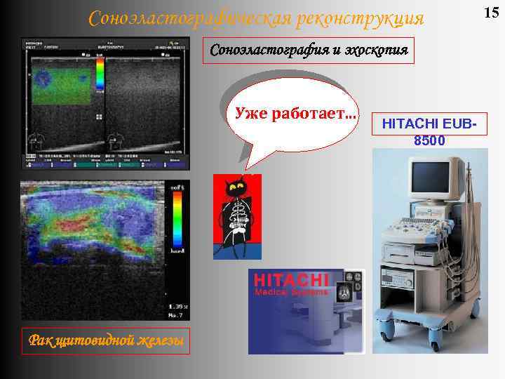 Соноэластографическая реконструкция Соноэластография и эхоскопия Уже работает. . . Рак щитовидной железы HITACHI EUB